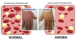 anemia2.jpg