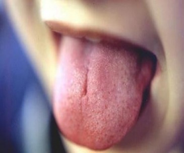 اختلالات سطح زبان