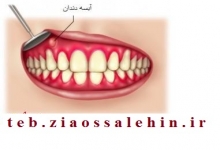 روش درمان آبسه دندان و روش های پیشگیری آن