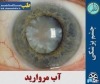 بیماری چشم
