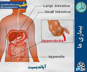 آپاندیسیت