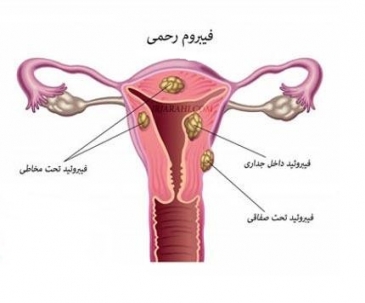 فیبروم رحمی